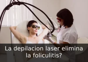 foliculitis y depilacion laser